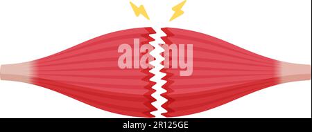 Illustration du vecteur de rupture musculaire ( déchirure complète ) Illustration de Vecteur