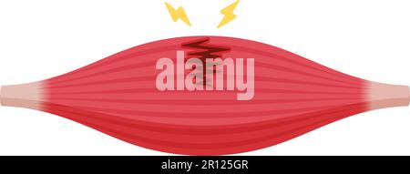 Illustration du vecteur de rupture musculaire (déchirure partielle ) Illustration de Vecteur
