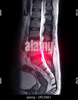 IRM rachis L-S ou rachis lambar sagittal T2 technique pour le diagnostic de la compression de la moelle épinière. Banque D'Images