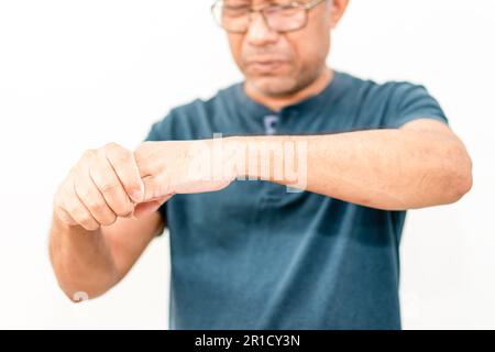 Un homme distal syndrome de Guillain-Barré (DGBS), qui se présente habituellement avec une participation principalement motrice, et est indiscernable de celui trouvé dans Banque D'Images