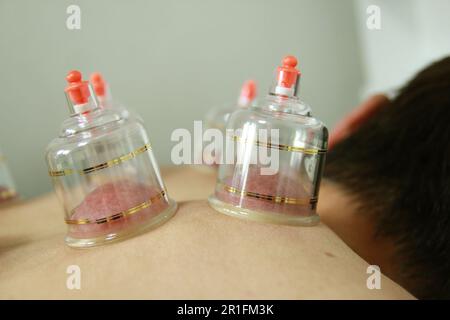 Concept image de la cupping et de la médecine, une médecine orientale traditionnelle Banque D'Images