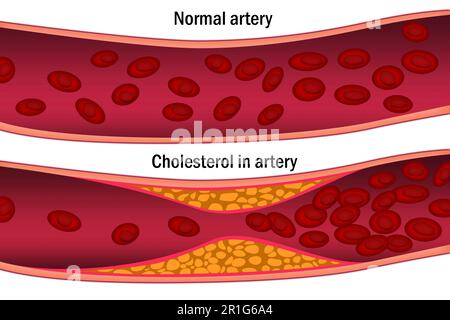 Cholestérol dans l'artère. Concept médical, rendu 3D Banque D'Images