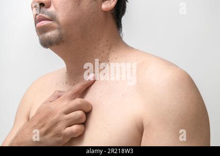 l'homme âgé d'âge moyen pointe vers des étiquettes de peau ou d'acrochordon sur son cou isolé sur fond blanc. Concept de soins de santé Banque D'Images