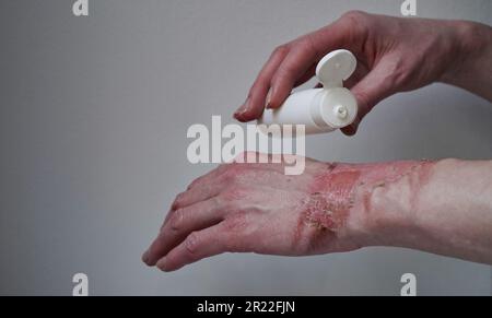 Mockup bouteille avec crème de guérison onguent femme brûlé à la main avec de l'eau bouillante avec éclatement blister, peau endommagée, brûlures à 1st ou 2nd degrés.plaie douloureuse.T Banque D'Images