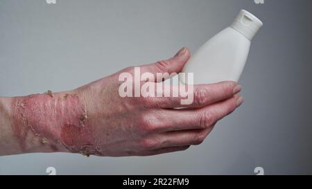 Mockup bouteille avec crème de guérison onguent femme brûlé à la main avec de l'eau bouillante avec éclatement blister, peau endommagée, brûlures à 1st ou 2nd degrés.plaie douloureuse.T Banque D'Images