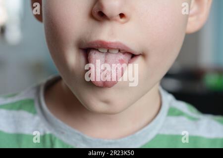 Taches blanches sur la langue enfant. La muguet buccal est une infection fongique qui affecte les tissus mous à l'intérieur de la bouche. Il est assez fréquent chez les jeunes enfants. Banque D'Images