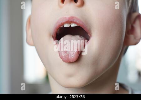 Taches blanches sur la langue. La muguet buccal est une infection fongique qui affecte les tissus mous à l'intérieur de la bouche. Il est assez fréquent chez les jeunes enfants. Banque D'Images