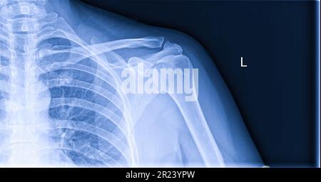 Image radiographique de la douleur de l'épaule, tendinite du ligament de l'épaule, tension musculaire de l'épaule Banque D'Images