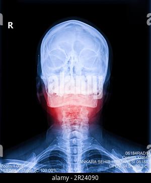 Radiographie du cou et du rachis cervical. Image de radiographie d'un patient souffrant de douleurs au cou et à la mâchoire, de compression des racines nerveuses Banque D'Images