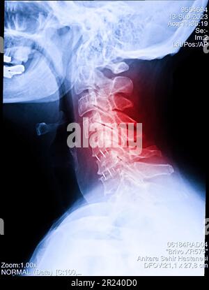 Radiographie du cou et du rachis cervical. Image d'une radiographie d'un patient souffrant de douleurs au cou, de compression des racines nerveuses, d'engourdissement au niveau du poignet ou de la nageoire de la main du bras Banque D'Images