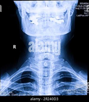 Radiographie du rachis cervical humain, radiographie du cou Banque D'Images