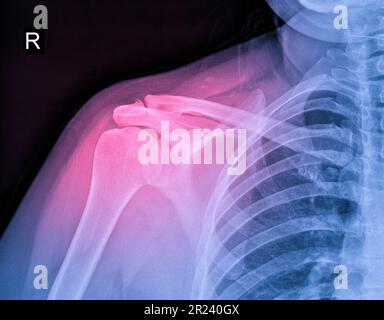 Image radiographique de la douleur de l'épaule, tendinite du ligament de l'épaule, tension musculaire de l'épaule Banque D'Images