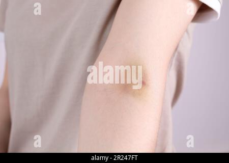 Gros plan main de la femme avec hématome, ecchymoses après injection, prélèvement sanguin sur fond gris. Blessure, phlébite post-injection. Horizontale Banque D'Images