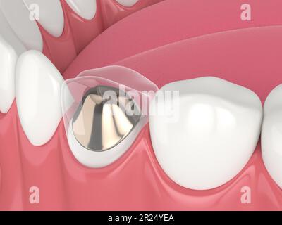 3d rendu de la mâchoire inférieure avec post moulé et restauration de la dent de noyau sur fond blanc Banque D'Images