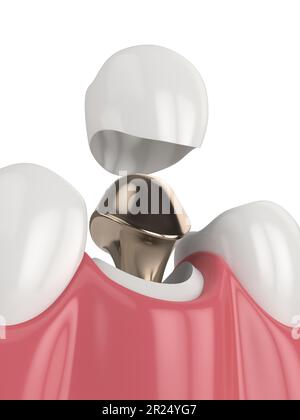 3d rendu de la mâchoire inférieure avec post moulé et restauration de la dent de noyau sur fond blanc Banque D'Images
