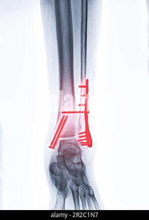 Image radiographique de l'articulation de la cheville montrant la fixation interne avec la plaque et la vis. Banque D'Images