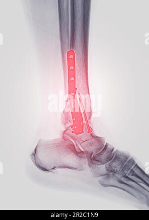 Image radiographique de l'articulation de la cheville montrant la fixation interne avec la plaque et la vis. Banque D'Images