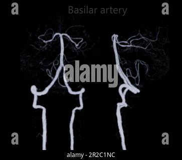 Angiographie CT du cerveau ou CTA du cerveau montrant une artère basilaire. Banque D'Images