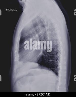 Radiographie thoracique ou radiographie image du poumon humain vue latérale avec inspiration complète pour détecter les maladies cardiaques et pulmonaires . vérifier le concept. Banque D'Images