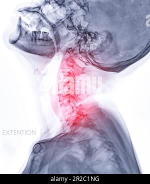 Radiographie du rachis cervical ou image radiographique du rachis cervical vue d'extension pour diagnostic hernie intervertébral disque, spondylosis et fracture. Banque D'Images