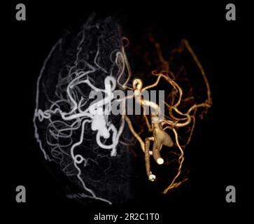 Angiographie CT du cerveau ou CTA du cerveau montrant l'artère cérébrale. Banque D'Images