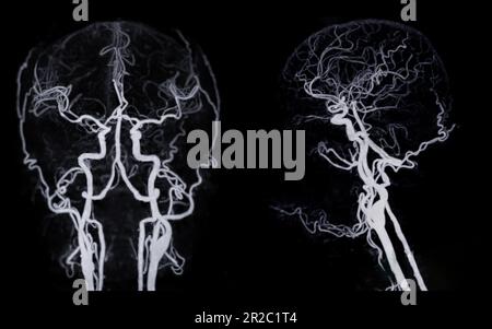 Angiographie CT du cerveau ou CTA du cerveau montrant l'artère cérébrale. Banque D'Images