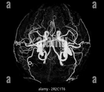 Angiographie CT du cerveau ou CTA du cerveau montrant l'artère cérébrale. Banque D'Images