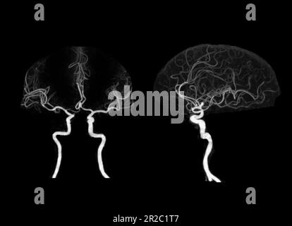 Angiographie CT du cerveau ou CTA du cerveau montrant l'artère cérébrale. Banque D'Images