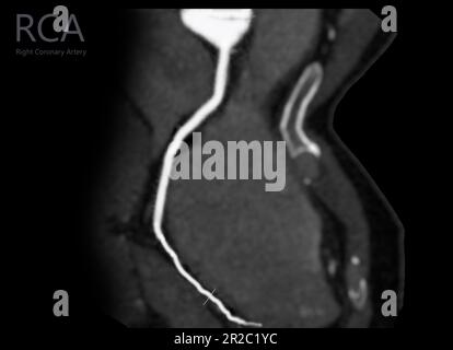 Courbe de l'artère coronaire CTA avec affichage de l'artère coronaire droite . Banque D'Images