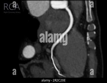Courbe de l'artère coronaire CTA avec affichage de l'artère coronaire droite . Banque D'Images