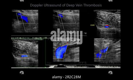 Détermination par échographie Doppler couleur chez les patients présentant une thrombose veineuse profonde pour détecter une thrombose veineuse profonde du membre inférieur. Banque D'Images