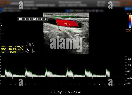 Une échographie Doppler de l'artère carotide est un test de diagnostic utilisé pour vérifier les artères dans le cou pour le diagnostic de tout blocage dans les veines par une cl de sang Banque D'Images