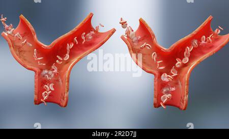 Drépanocytose, illustration 3d médicalement précise de la maladie de la faucille, vaisseau sanguin avec des globules rouges normaux et des globules rouges faucillés, non Banque D'Images