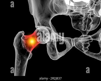 Fracture du col du fémur, illustration Banque D'Images