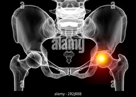 Douleurs articulaires de la hanche, illustration conceptuelle Banque D'Images