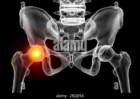 Douleurs articulaires de la hanche, illustration conceptuelle Banque D'Images
