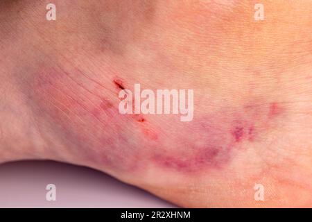 Ecchymose. Grand ecchymose. Ecchymoses par injection. Médecin et patient Banque D'Images