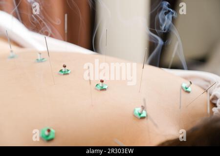Une femme avec une aiguille coincée dans une clinique d'acupuncture lumineuse Banque D'Images