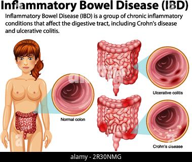 Illustration infographique des maladies inflammatoires de l'intestin (MII) Illustration de Vecteur