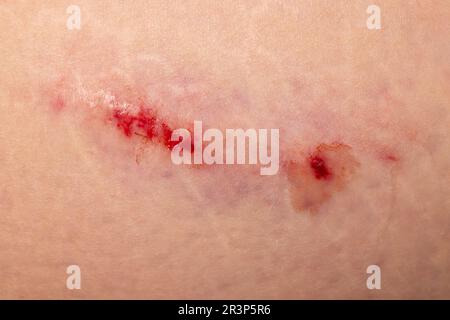 Ecchymose. Grand ecchymose. Ecchymoses par injection. Médecin et patient. Banque D'Images