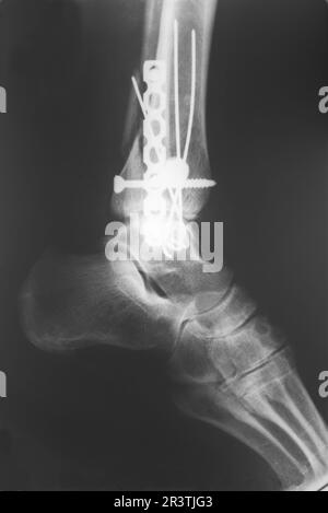 Rayons X de la jambe cassée Banque D'Images