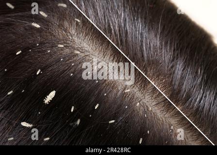 Collage montrant les cheveux de la femme avant et après le traitement des poux, gros plan. Souffrant de pédiculose Banque D'Images
