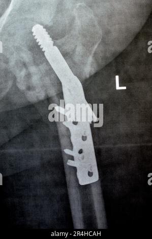 Col cervical trans de la hanche gauche de la fracture du fémur fixé par DHS Dynamic Hip Screw, PXR à rayons X simple d'un ancien patient, un orthopédique épargnant la tête fémorale Banque D'Images