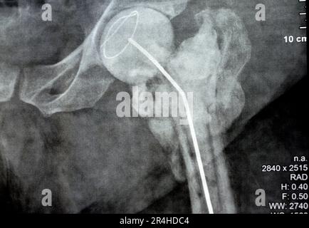 L'articulation de la hanche à rayons X simple montre une fracture cervicale trans gauche de la tête du fémur avec un chargeur d'antibiotiques temporaire, un ciment osseux chargé d'antibiotiques à l'arrière Banque D'Images