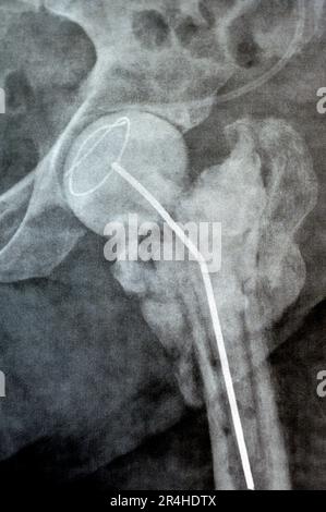 L'articulation de la hanche à rayons X simple montre une fracture cervicale trans gauche de la tête du fémur avec un chargeur d'antibiotiques temporaire, un ciment osseux chargé d'antibiotiques à l'arrière Banque D'Images