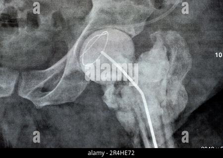 L'articulation de la hanche à rayons X simple montre une fracture cervicale trans gauche de la tête du fémur avec un chargeur d'antibiotiques temporaire, un ciment osseux chargé d'antibiotiques à l'arrière Banque D'Images