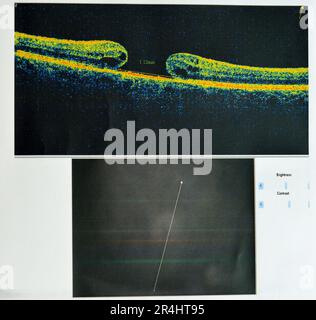 OCT de l'œil révèle une membrane épimaculaire faible et un trou maculaire pleine épaisseur impliquant la fovéa, entourant l'œdème maculaire diffus montrant peu de c Banque D'Images