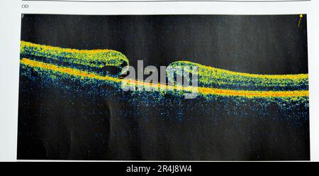OCT de l'œil révèle une membrane épimaculaire faible et un trou maculaire pleine épaisseur impliquant la fovéa, entourant l'œdème maculaire diffus montrant peu de c Banque D'Images
