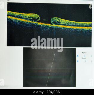 OCT de l'œil révèle une membrane épimaculaire faible et un trou maculaire pleine épaisseur impliquant la fovéa, entourant l'œdème maculaire diffus montrant peu de c Banque D'Images