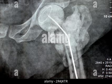 L'articulation de la hanche à rayons X simple montre une fracture cervicale trans gauche de la tête du fémur avec un chargeur d'antibiotiques temporaire, un ciment osseux chargé d'antibiotiques à l'arrière Banque D'Images